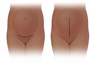 Abdomen de una persona embarazada donde se observa una incisión transversal baja. Abdomen de una persona embarazada donde se observa una incisión vertical en la línea media.